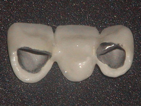 PFM Bridge with Margin Porcelain 