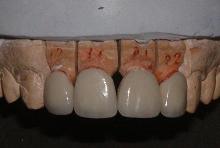 Anterior PFM Crowns