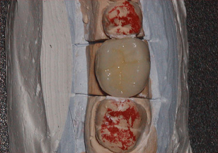 Posterior PFM Crown 